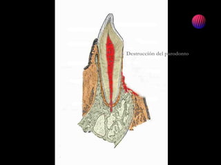 Destrucción del parodonto
 