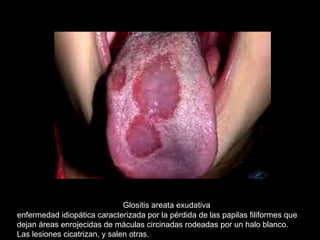 Glositis areata exudativa
enfermedad idiopática caracterizada por la pérdida de las papilas filiformes que
dejan áreas enrojecidas de máculas circinadas rodeadas por un halo blanco.
Las lesiones cicatrizan, y salen otras.
 