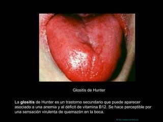 --
Glositis de Hunter
La glositis de Hunter es un trastorno secundario que puede aparecer
asociado a una anemia y al déficit de vitamina B12. Se hace perceptible por
una sensación virulenta de quemazón en la boca.
> http://www.onmeda.es
 