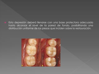  Esta depresión deberá llenarse con una base protectora adecuada 
hasta alcanzar el nivel de la pared de fondo, posibilitando una 
distribución uniforme de las piezas que inciden sobre la restauración. 
 