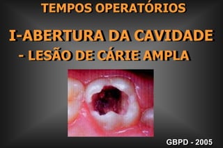     TEMPOS OPERATÓRIOSI-ABERTURA DA CAVIDADE- LESÃO DE CÁRIE AMPLAGBPD - 2005