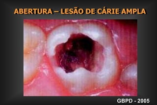 ABERTURA – LESÃO DE CÁRIE AMPLAGBPD - 2005