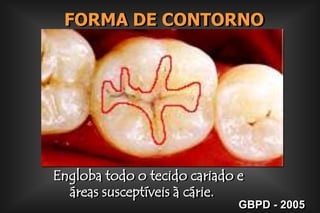 FORMA DE CONTORNO Engloba todo o tecido cariado e        áreas susceptíveis à cárie.GBPD - 2005