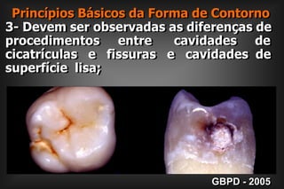  Princípios Básicos da Forma de Contorno3- Devem ser observadas as diferenças de procedimentos     entre      cavidades     de cicatrículas   e   fissuras   e   cavidades  de superfície  lisa;GBPD - 2005