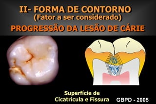 II- FORMA DE CONTORNO      (Fator a ser considerado) PROGRESSÃO DA LESÃO DE CÁRIE Auto Limpeza;