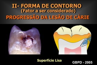  Direção dos prismas de esmalte;