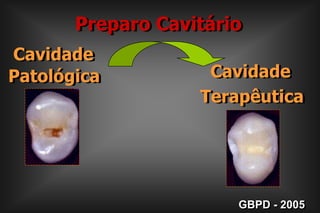  Cavidade Patológica  Cavidade TerapêuticaPreparo CavitárioGBPD - 2005