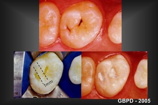 II- FORMA DE CONTORNO      (Fator a ser considerado) 2. EXTENSÃO PREVENTIVA    Cicatrículas e Fissuras Envolver todas as cicatrículas ,      fissuras e sulcos profundos. Respeitar as estruturas de reforço.GBPD - 2005