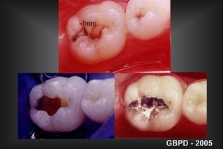 II- FORMA DE CONTORNO         (Fator a ser considerado) 2. EXTENSÃO PREVENTIVA     Cicatrículas e FissurasGBPD - 2005