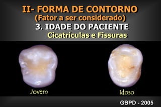 > 1mm< 1mmII- FORMA DE CONTORNO      (Fator a ser considerado) 2. EXTENSÃO PREVENTIVA      Cicatrículas e FissurasGBPD - 2005