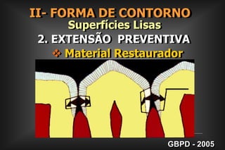 II- FORMA DE CONTORNO      (Fator a ser considerado)1. EXTENSÃO  DA CÁRIE        Superfícies LisasPROGRESSÃO DA LESÃO DE CÁRIEGBPD - 2005