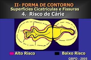 II- FORMA DE CONTORNO        Superfícies Lisas2. EXTENSÃO  PREVENTIVA Para Gengival   - Idade do Paciente Na extensão Preventiva para Gengival as   margens   cavitárias proximais poderão situar-se Aquém,  ao Nível ou Além da gengiva marginal livre.GBPD - 2005