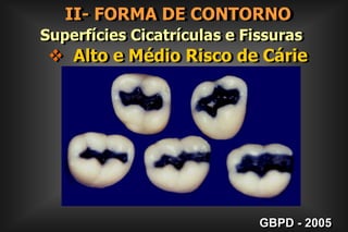 II- FORMA DE CONTORNO        Superfícies Lisas2. EXTENSÃO  PREVENTIVA Para GengivalMaterial Restaurador  Provisórios e Temporários