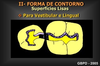 II- FORMA DE CONTORNO Superfícies Cicatrículas e Fissuras4.  Risco de CárieBaixo RiscoAlto RiscoGBPD - 2005