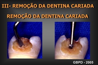 II- FORMA DE CONTORNO Superfícies Cicatrículas e Fissuras  Alto e Médio Risco de CárieGBPD - 2005