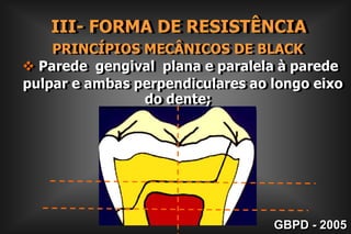 II- FORMA DE CONTORNO        Superfícies Lisas2. EXTENSÃO  PREVENTIVA Para Vestibular e Lingual