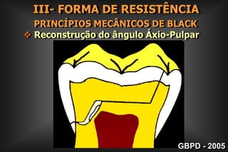 II- FORMA DE CONTORNO        Superfícies Lisas2. EXTENSÃO  PREVENTIVA Para Vestibular e Lingual0,2 à 0,5 mmGBPD - 2005