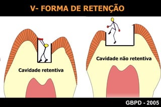     TEMPOS OPERATÓRIOSIII- REMOÇÃO DA DENTINA CARIADA        É o Tempo Operatório que consiste na remoção de toda dentina que encontra-se desmineralizada e infectada, pela lesão de cárie, de modo irreversível.  REMOÇÃO DA DENTINA    CARIADAGBPD - 2005