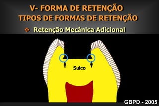 1a Zona – Dentina muito infectada                     e desorganizada2a Zona – Dentina infectada e                    desmineralizada3a Zona – Dentina desmineralizada                  não infectada, passível                     de remineralização        ZONAS  DA    LESÃO DE CÁRIEGBPD - 2005