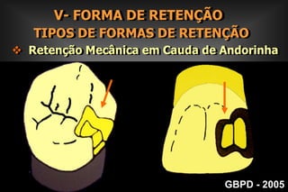 III- REMOÇÃO DA DENTINA CARIADA           RECURSOS PARA  EVIDENCIAÇÃO E REMOÇÃO       DA DENTINA CARIADAGBPD - 2005
