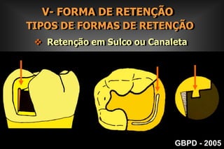 III- REMOÇÃO DA DENTINA CARIADA EVIDENCIAÇÃO DA DENTINA CARIADA           CORANTESFucsina básica 0.5 ml em   100 ml de propileno glicolGBPD - 2005