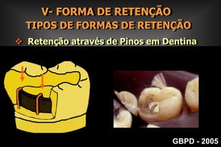 III- REMOÇÃO DA DENTINA CARIADA   REMOÇÃO DA DENTINA CARIADAGBPD - 2005