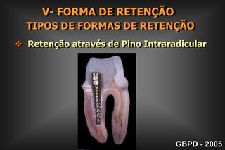     TEMPOS OPERATÓRIOS      FORMA         DERESISTÊNCIA        III- FORMA DE RESISTÊNCIA        É o Tempo Operatório que consiste em se dar forma à cavidade para que a estrutura dental e material restaurador possam resistir aos:GBPD - 2005
