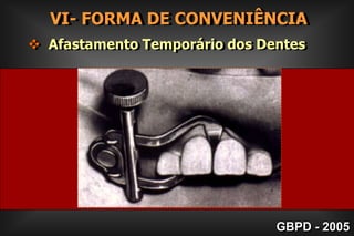 Esmalte sem suporte dentinário        III- FORMA DE RESISTÊNCIAPRINCÍPIOS MECÂNICOS DE BLACK Todo esmalte deverá estar suportado por     dentina sadia;Esmalte após     preparoGBPD - 2005