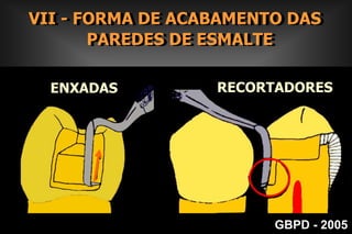         III- FORMA DE RESISTÊNCIAPRINCÍPIOS MECÂNICOS DE BLACK Reconstrução do ângulo Áxio-PulparGBPD - 2005