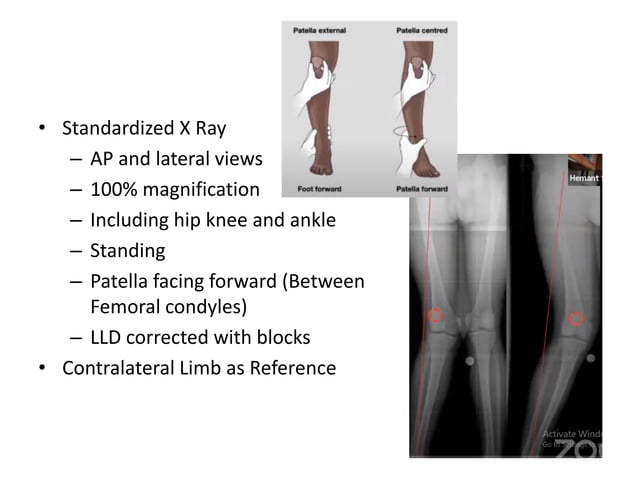 Principle of Deformity Correction in lower Limb | PPTX | Death, Injury ...
