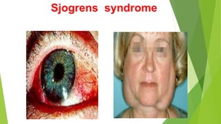 Sjogrens syndrome
 