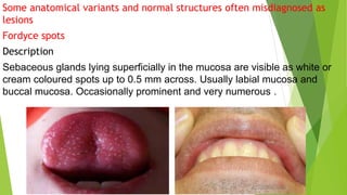 Some anatomical variants and normal structures often misdiagnosed as
lesions
Fordyce spots
Description
Sebaceous glands lying superficially in the mucosa are visible as white or
cream coloured spots up to 0.5 mm across. Usually labial mucosa and
buccal mucosa. Occasionally prominent and very numerous .
 