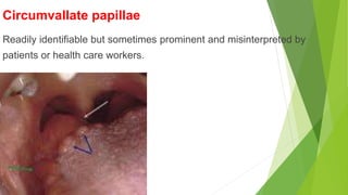 Circumvallate papillae
Readily identifiable but sometimes prominent and misinterpreted by
patients or health care workers.
 