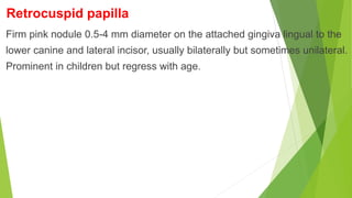 Retrocuspid papilla
Firm pink nodule 0.5-4 mm diameter on the attached gingiva lingual to the
lower canine and lateral incisor, usually bilaterally but sometimes unilateral.
Prominent in children but regress with age.
 