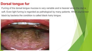 Dorsal tongue fur
Furring of the dorsal tongue mucosa is very variable and is heavier when the diet is
soft. Even light furring is regarded as pathological by many patients. When pigmented
black by bacteria the condition is called black hairy tongue.
 