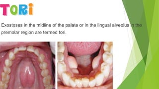 Exostoses in the midline of the palate or in the lingual alveolus in the
premolar region are termed tori.
 