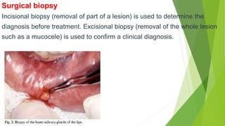 Surgical biopsy
Incisional biopsy (removal of part of a lesion) is used to determine the
diagnosis before treatment. Excisional biopsy (removal of the whole lesion
such as a mucocele) is used to confirm a clinical diagnosis.
 