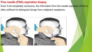 Fine needle (FNA) aspiration biopsy
Even if not completely conclusive, the information from fine needle aspiration (FNA) is
often sufficient to distinguish benign from malignant neoplasms.
 