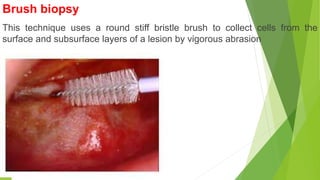 Brush biopsy
This technique uses a round stiff bristle brush to collect cells from the
surface and subsurface layers of a lesion by vigorous abrasion
 
