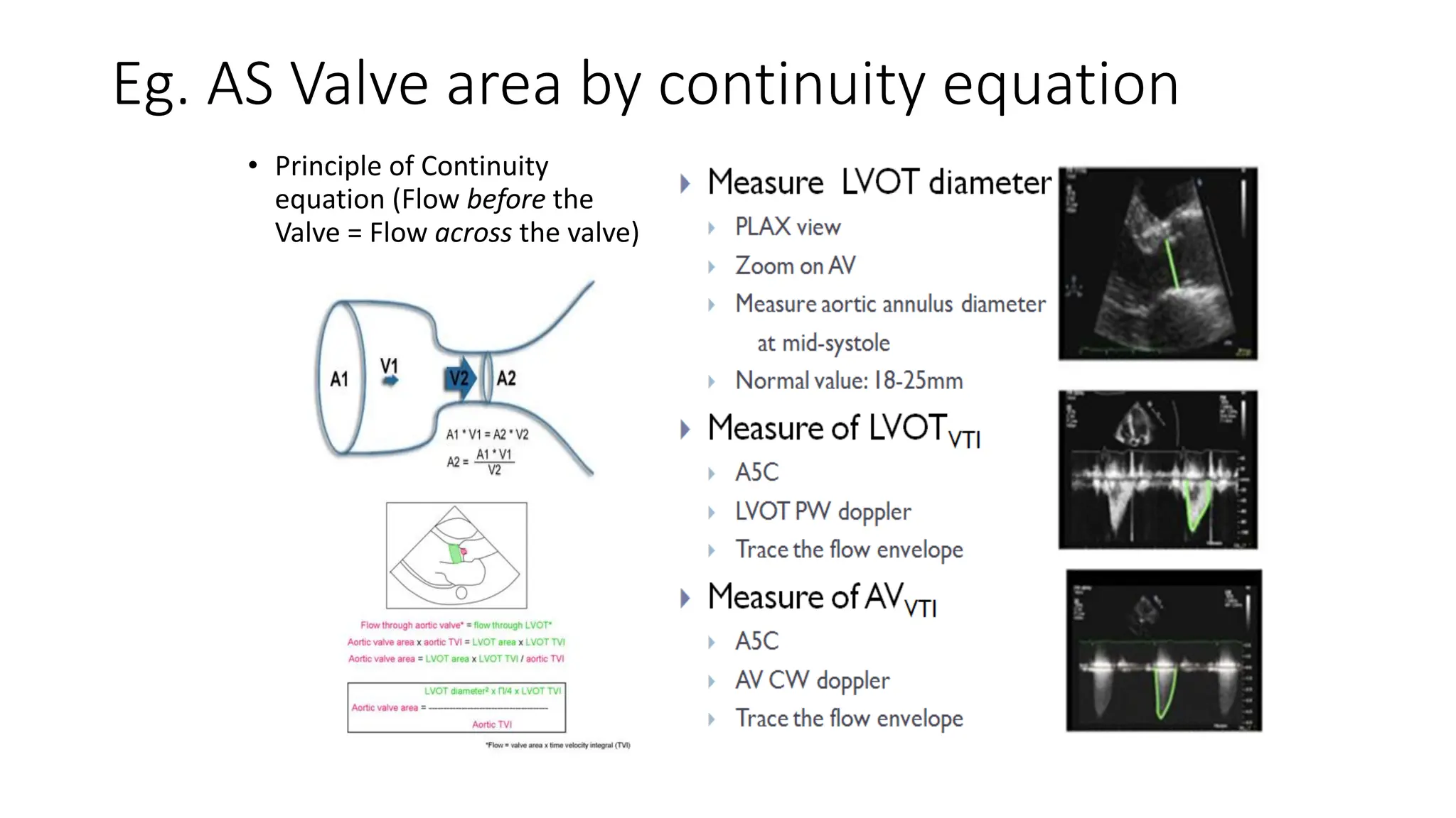 Eg. AS Valve area by continuity equation
• Principle of Continuity
equation (Flow before the
Valve = Flow across the valve)
 