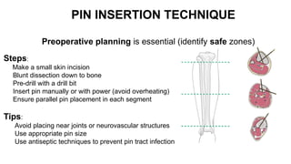 Principles External Fixator PRINCIPLE OF EXTERNAL FIXATOR orthopaedics | PPTX