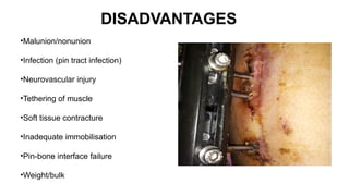 PRINCIPLE OF EXTERNAL FIXATOR orthopaedics | PPTX