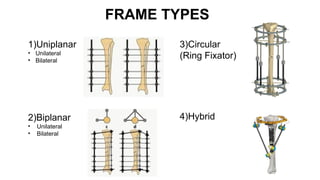 PRINCIPLE OF EXTERNAL FIXATOR orthopaedics | PPTX