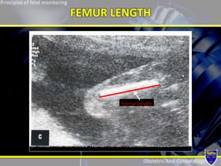 Principle of fetal monitoring | PPTX