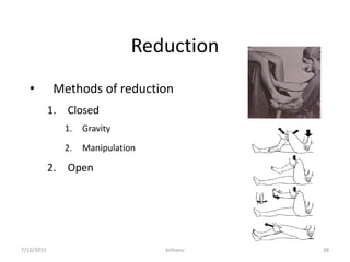 Principle of fracture managment | PPTX