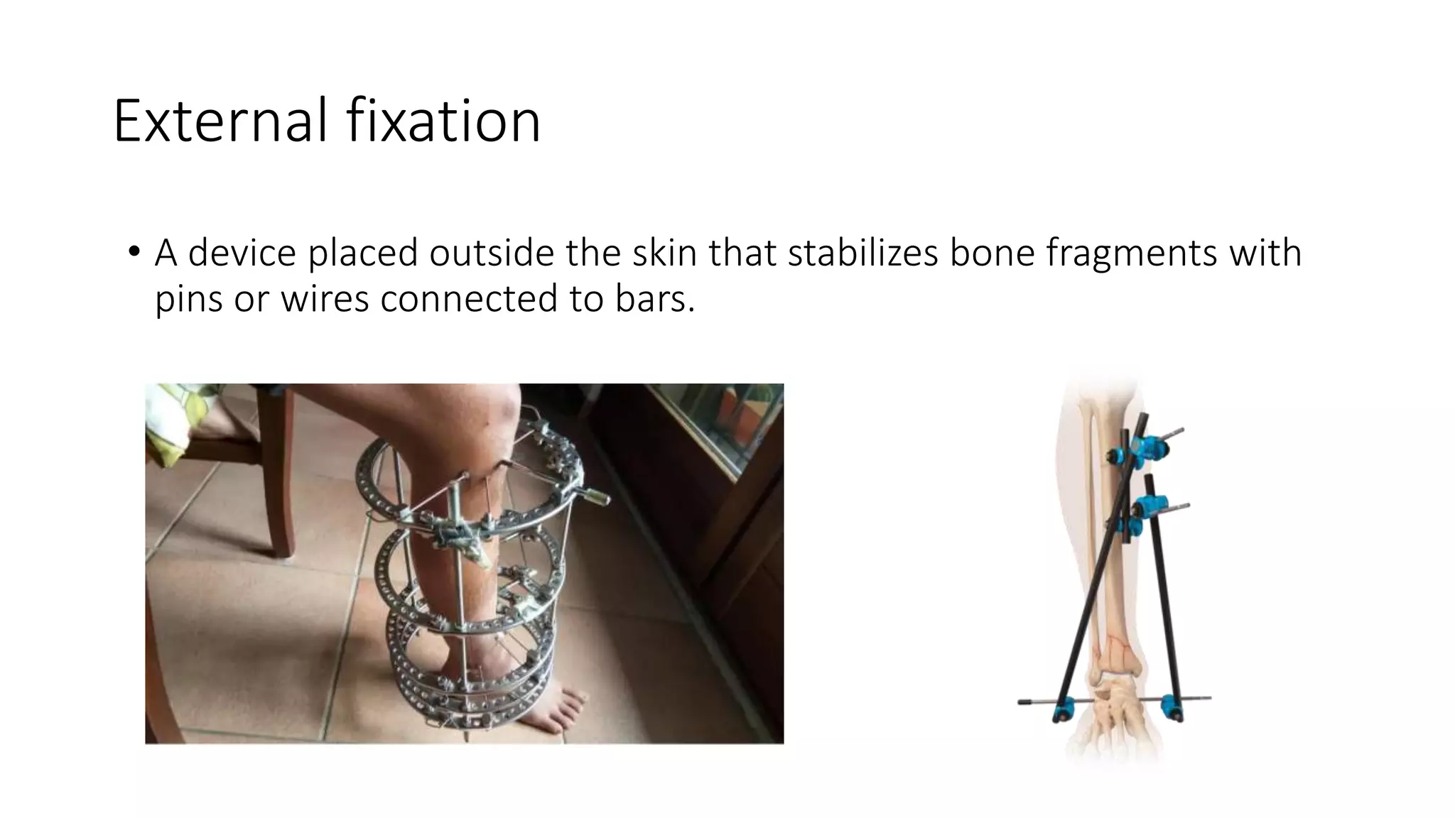 Principle of internal and external fixation slideshare | PPTX