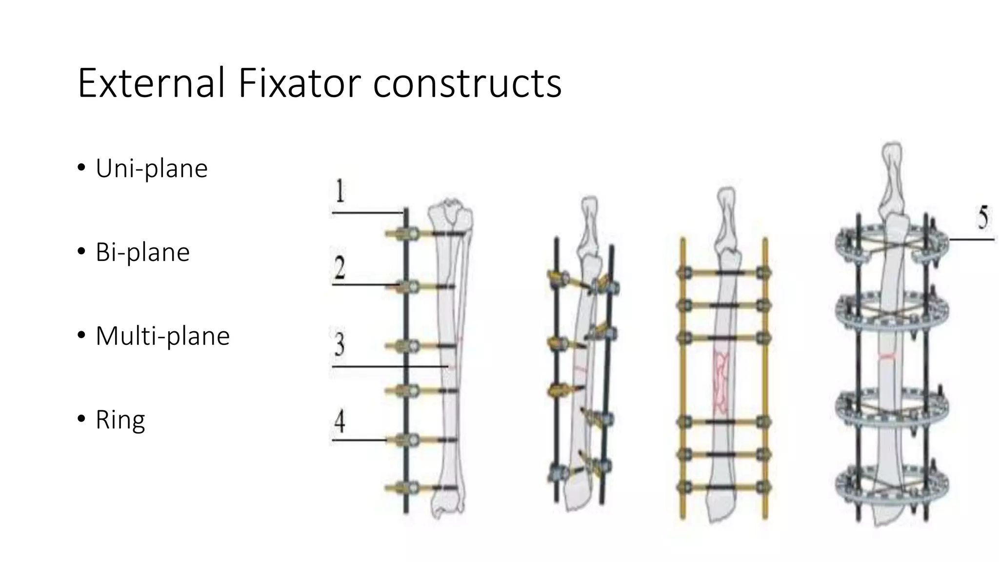 Principle of internal and external fixation slideshare | PPTX