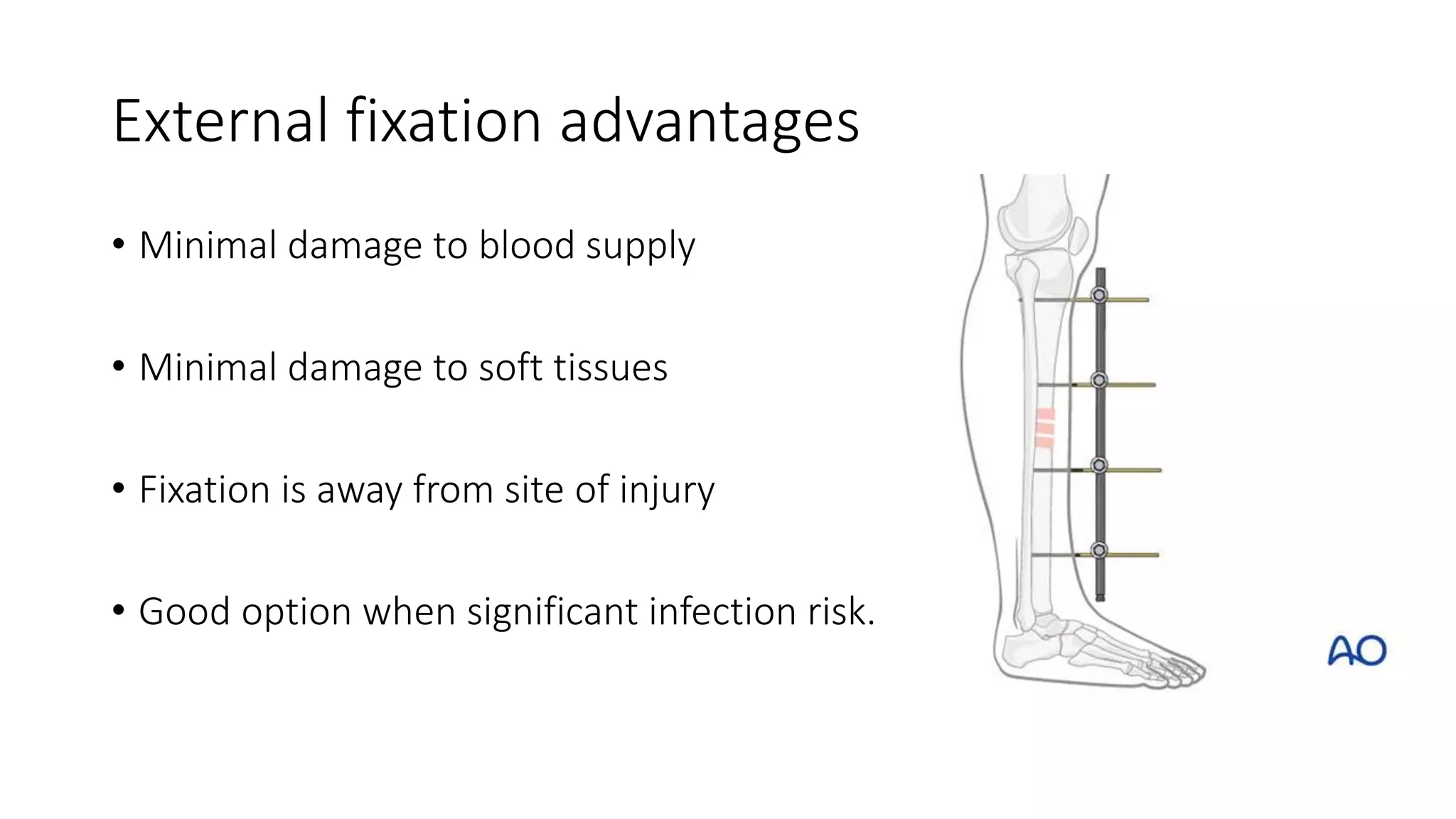 Principle of internal and external fixation slideshare | PPTX