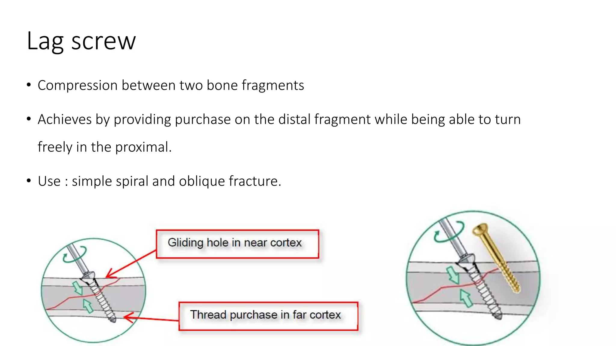 Principle of internal and external fixation slideshare | PPTX