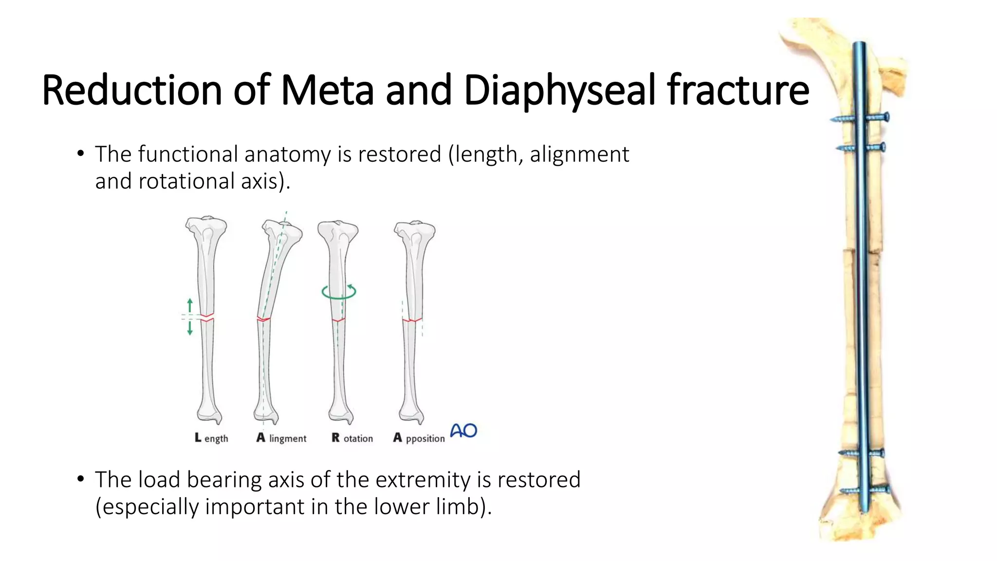 Principle of internal and external fixation slideshare | PPTX